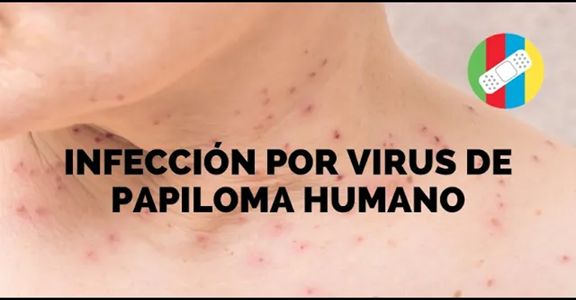 imagen del video INFECCIÓN POR VIRUS DE PAPILOMA HUMANO