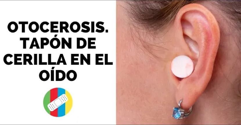 imagen del video OTOCEROSIS. Tapón de cerilla en el oído