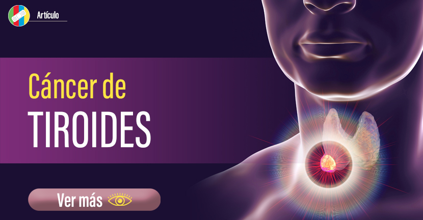 Cáncer de tiroides.