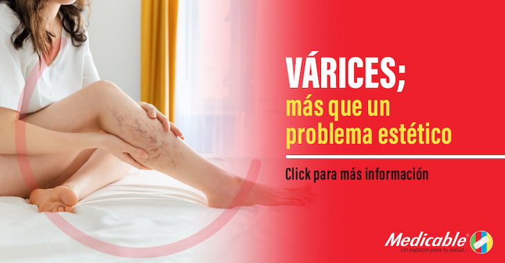 Várices, más que un problema estético