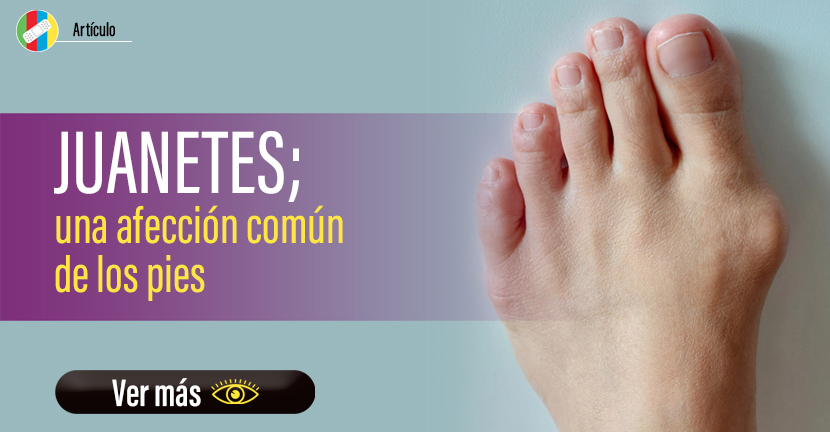 Juanetes, una afección común de los pies.