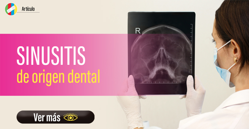 Sinusitis de origen dental.