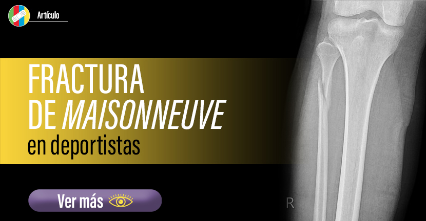 Fractura de Maisonneuve en deportistas.