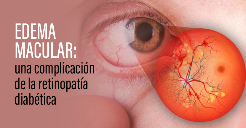 Edema macular: una complicación de la retinopatía diabética.