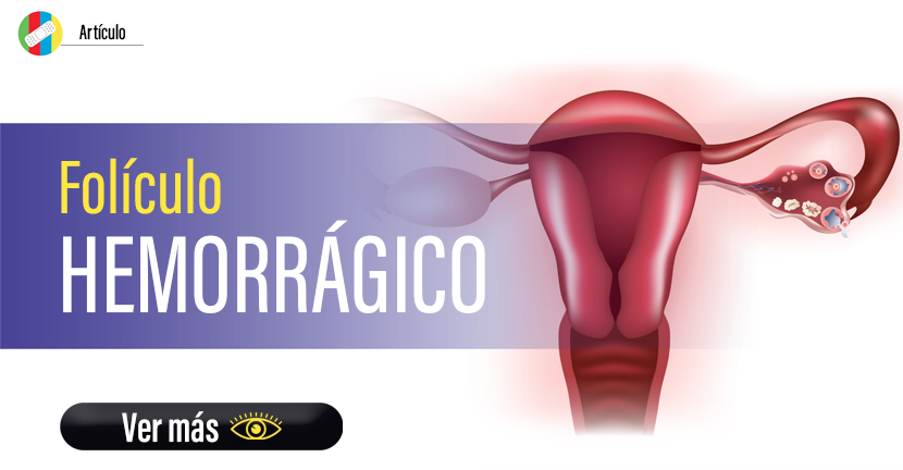 Folículo hemorrágico.