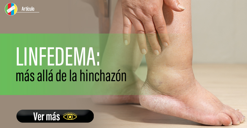 Linfedema: más allá de la hinchazón