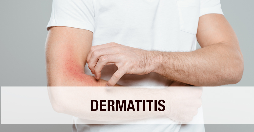 Dermatitis