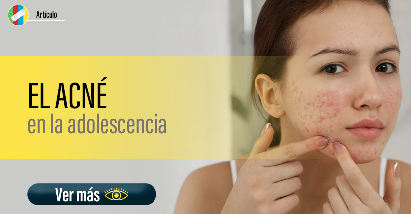 Acné en la adolescencia