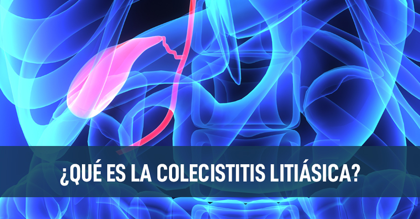 ¿Qué es la Colecistitis Litiásica?