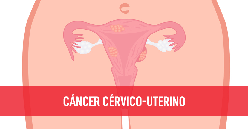 Cáncer Cervicouterino, Programa Micaela