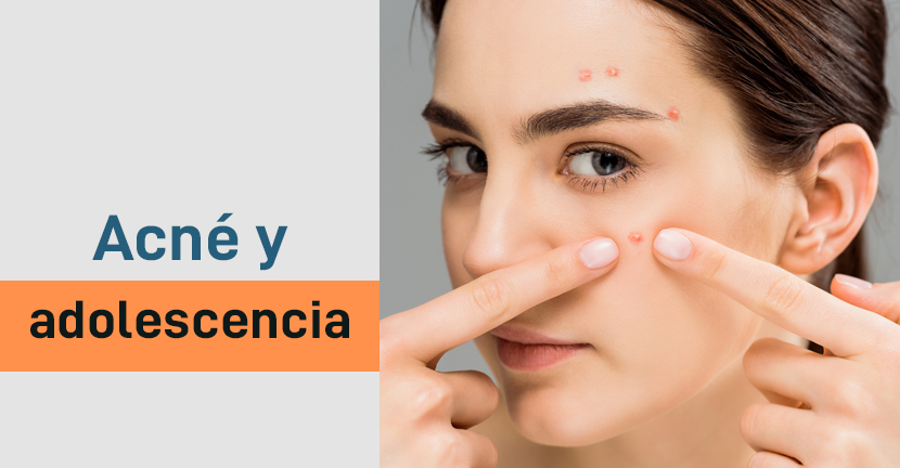Acné y adolescencia