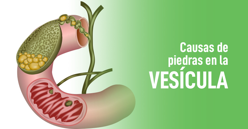 Causas de piedras en la vesícula 