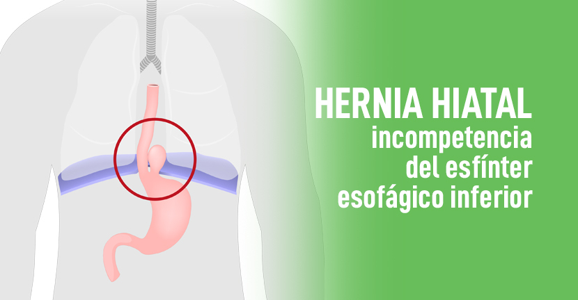 Hernia hiatal, incompetencia del esfínter esofágico inferior
