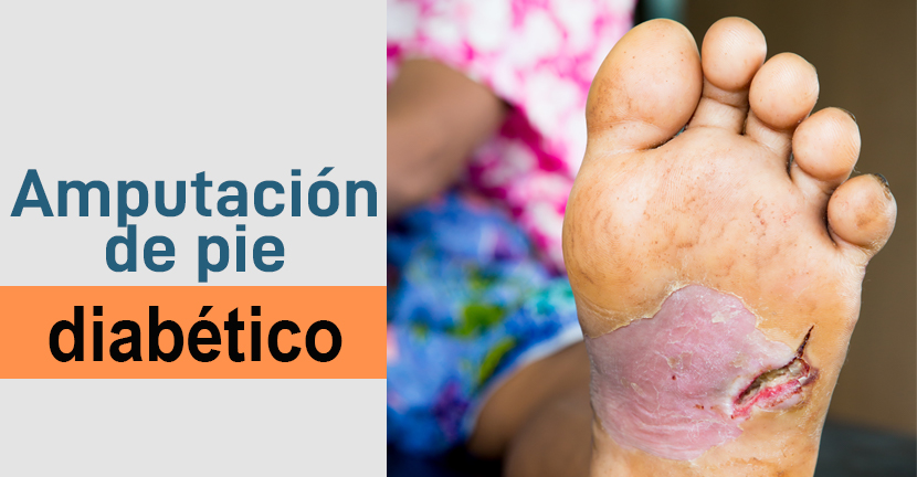 Amputación de pie diabético