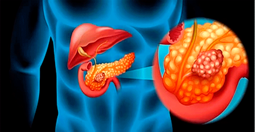Cáncer de Páncreas crear conciencia para una detección temprana y oportuna