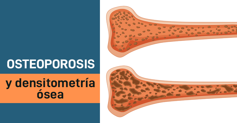 Osteoporosis y densitometría ósea
