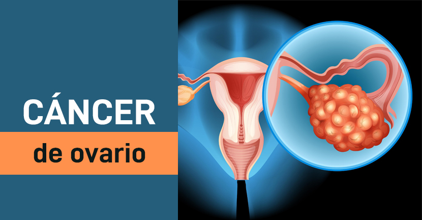 Cáncer de ovario