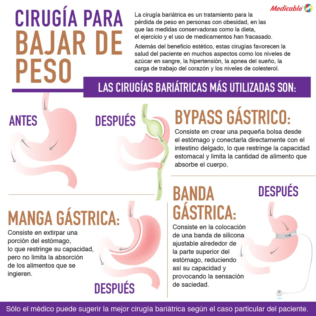 Cirugía para bajar de peso