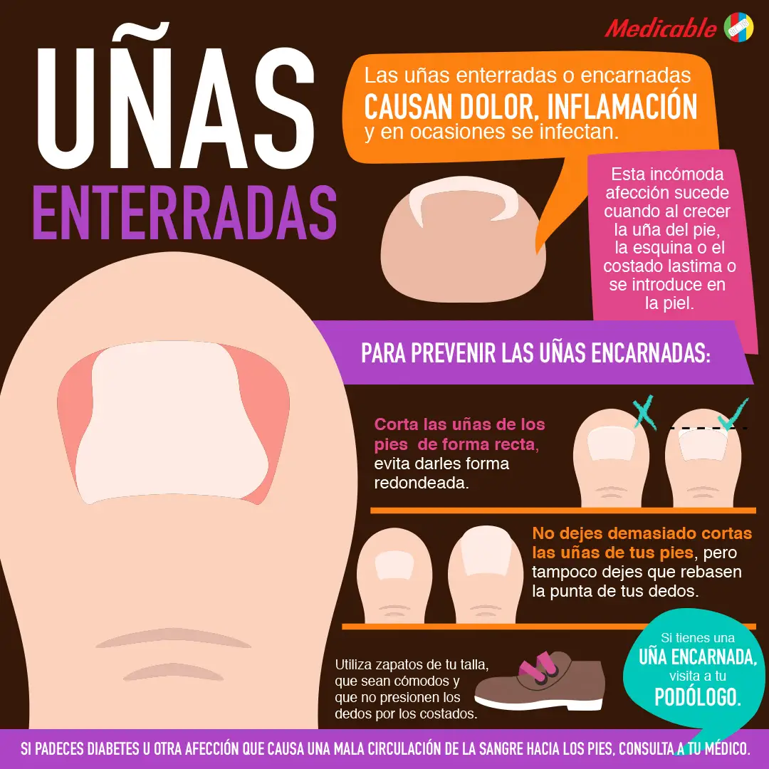 Uñas enterradas