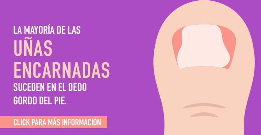 Uñas enterradas