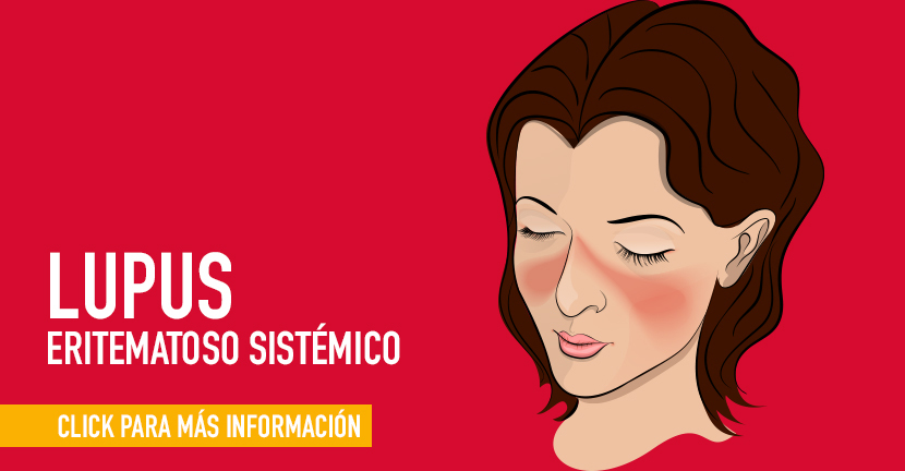 Lupus