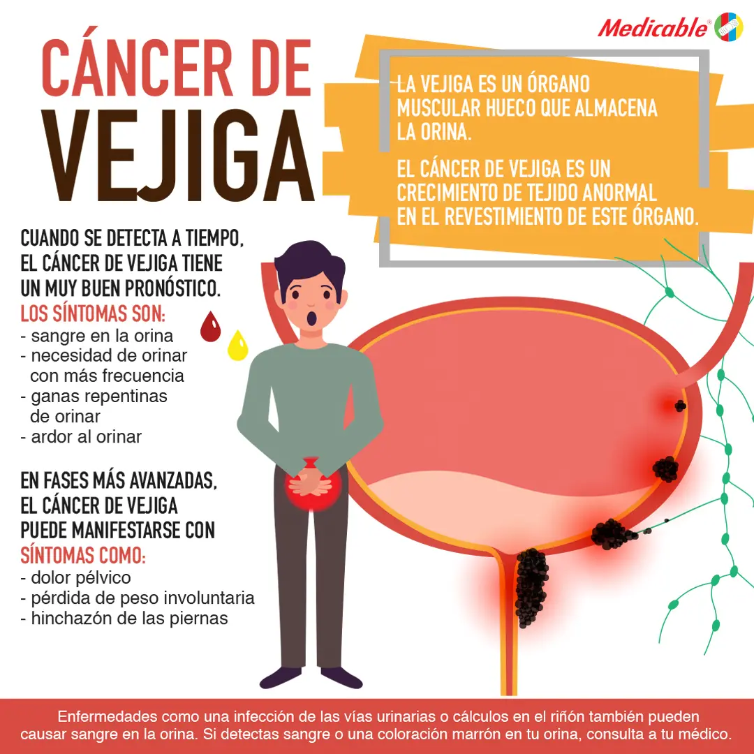 Cáncer de Vejiga