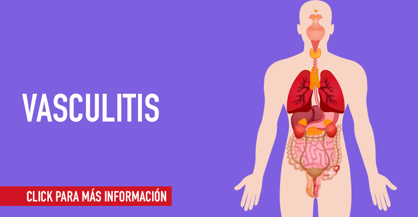 Vasculitis