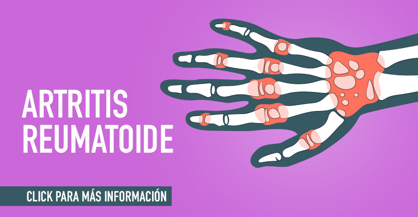 Artritis reumatoide recomendaciones dietéticas