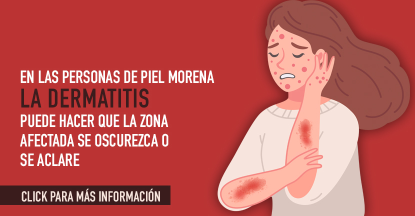 Tipos frecuentes de dermatitis