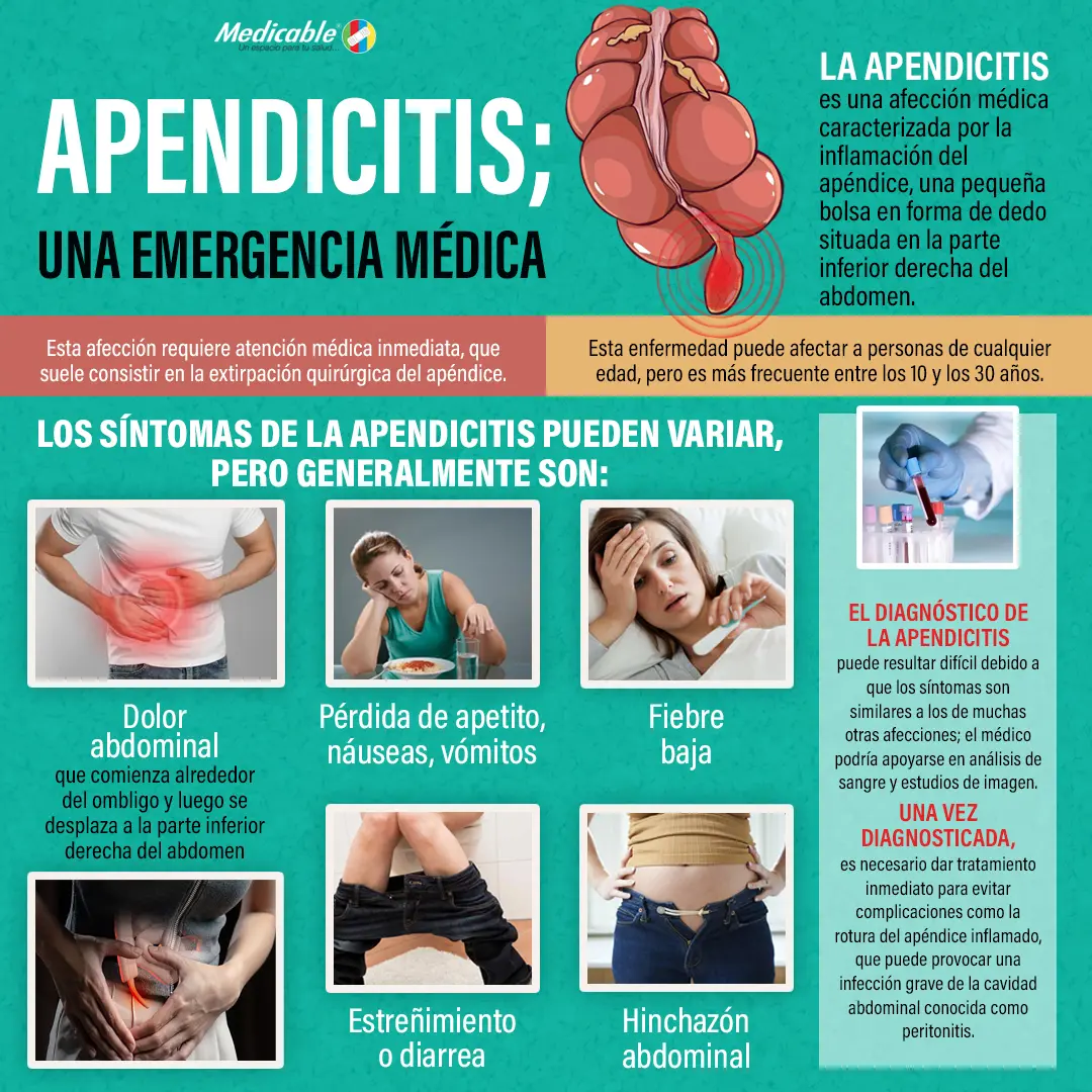 Apendicitis una emergencia médica