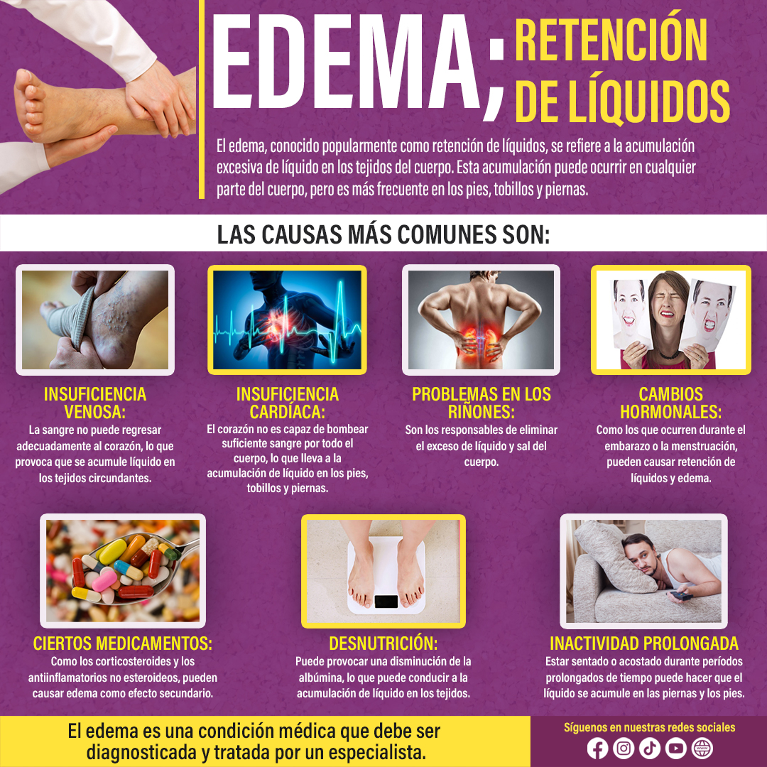 EDEMA; retención de líquidos