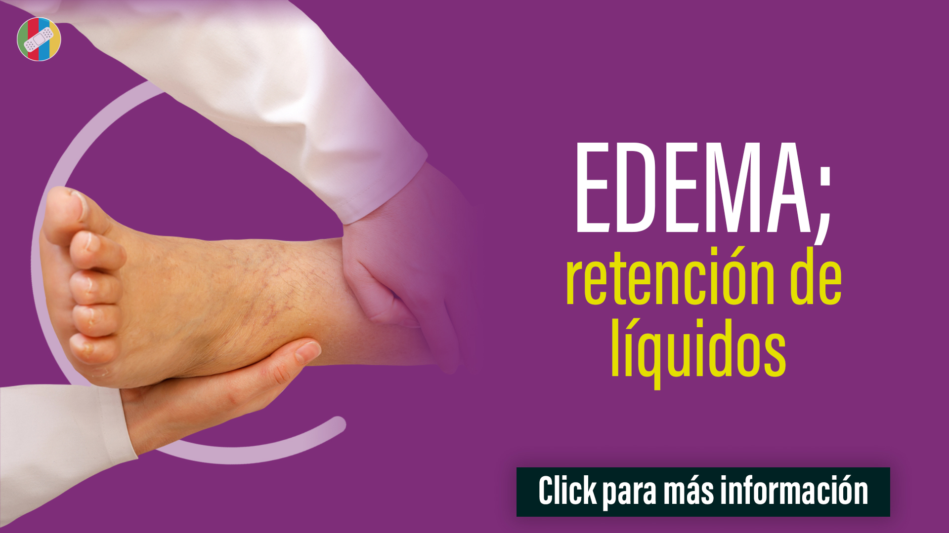 EDEMA; retención de líquidos