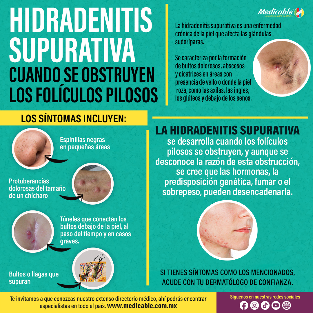 Hidradenitis supurativa; cuando se obstruyen los folículos pilosos. 