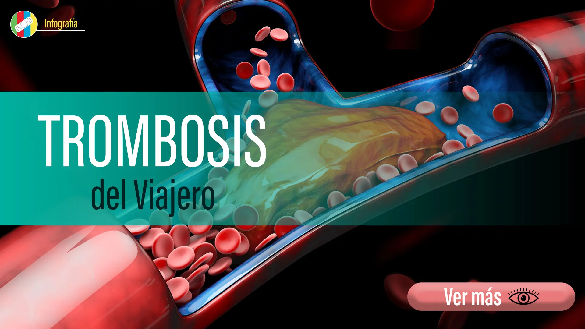 Trombosis del viajero.