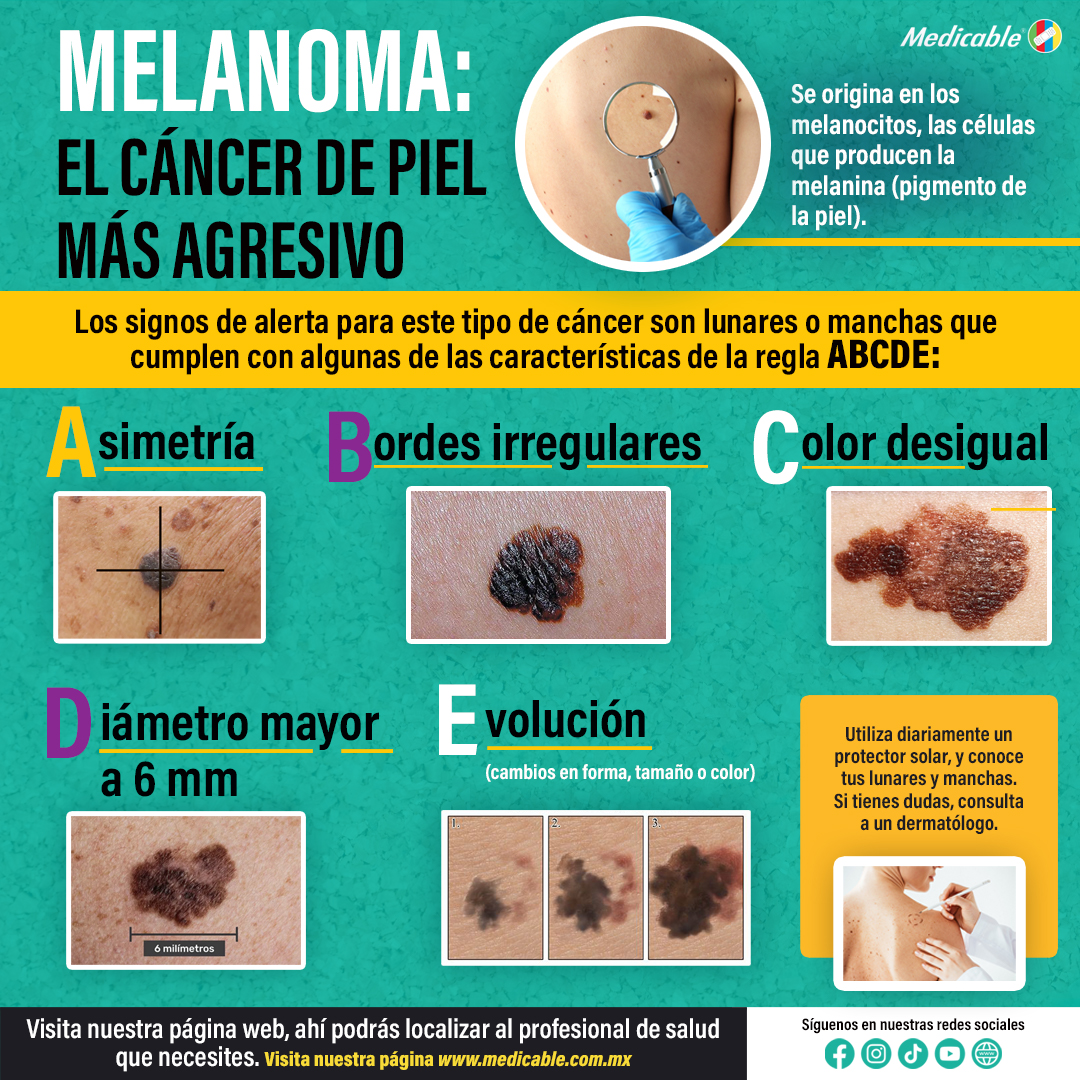 Melanoma, el cáncer de piel más agresivo.