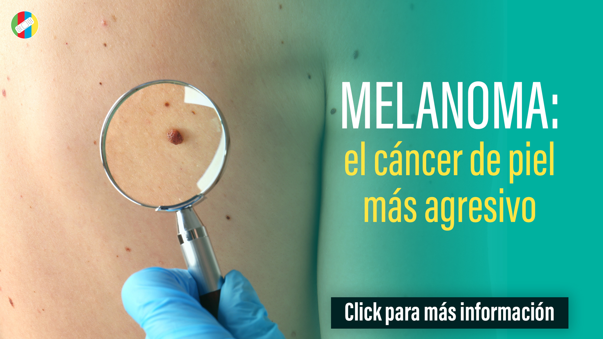 Melanoma, el cáncer de piel más agresivo.