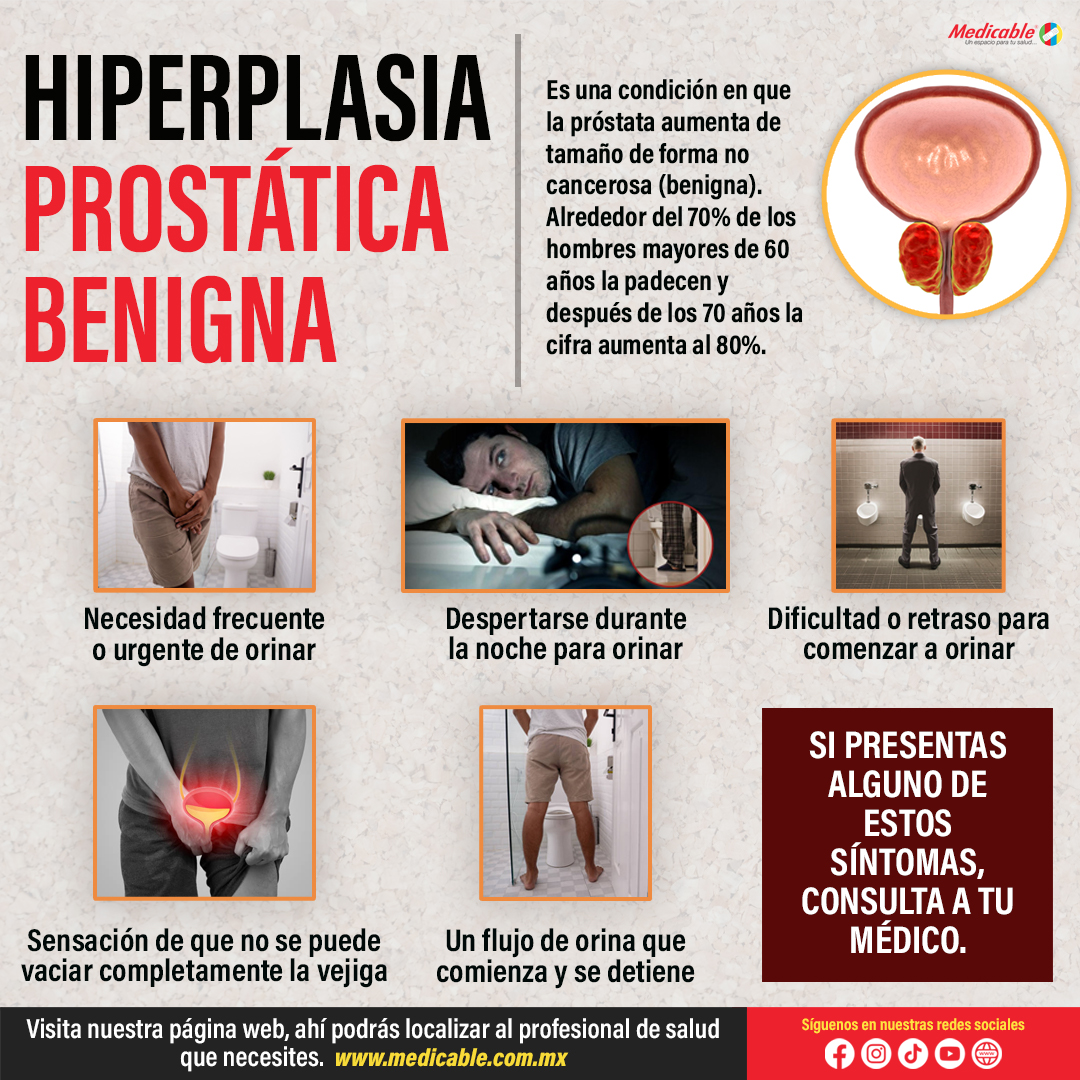 Hiperplasia prostática benigna.