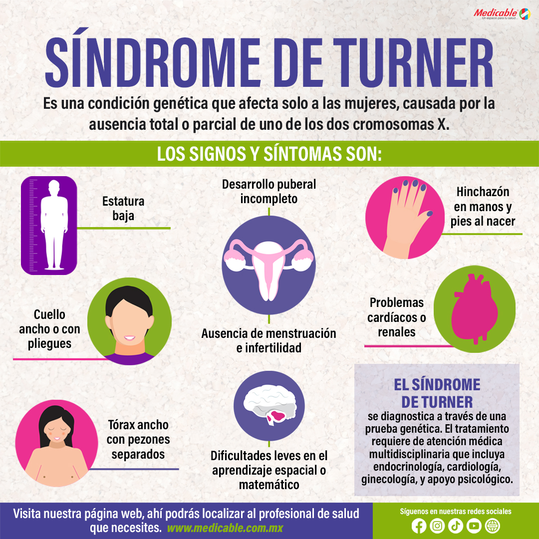 Síndrome de Turner