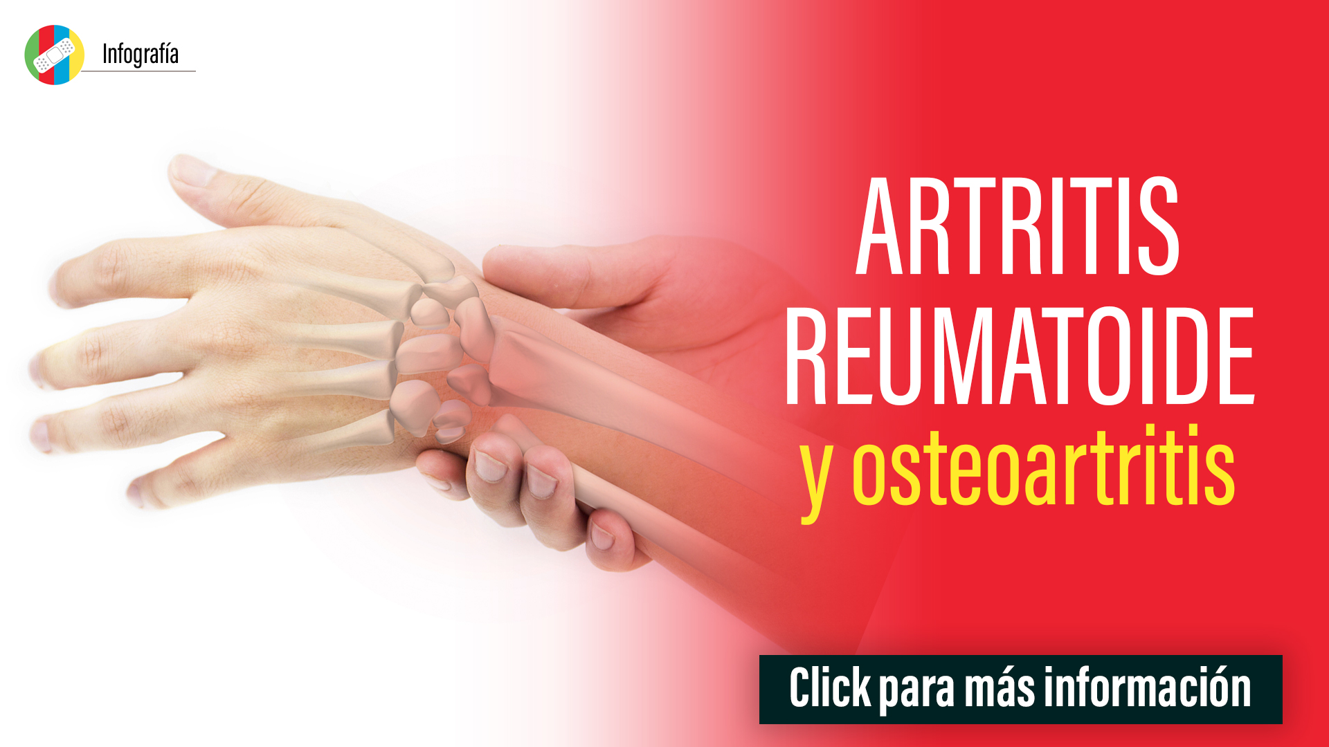 Artritis Reumatoide y Osteoartritis.
