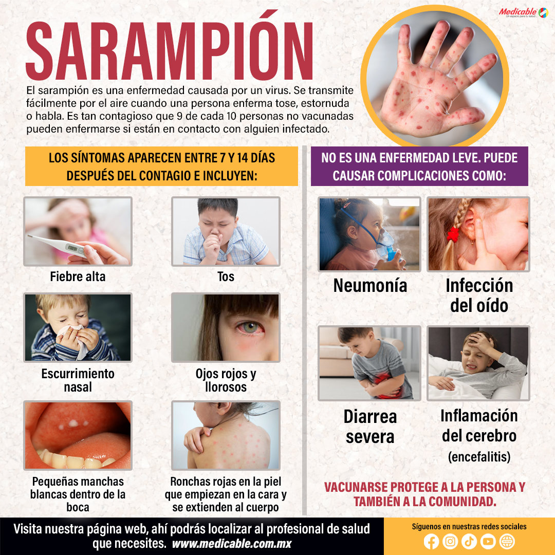 Sarampión